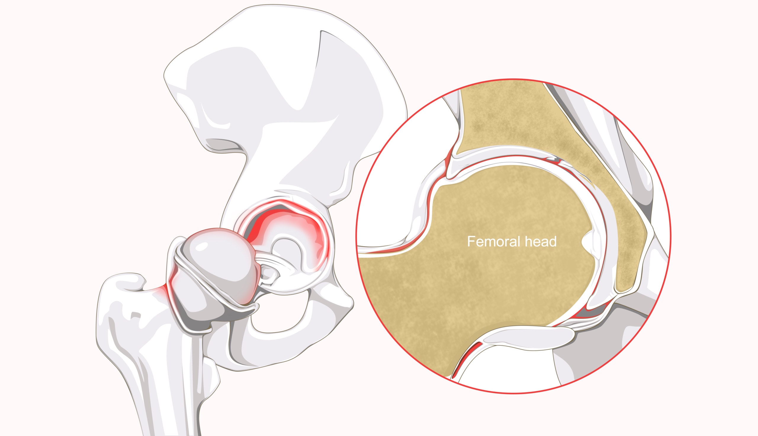 labral-tears-and-a-track-athlete-surgery-on-kids-regenexx