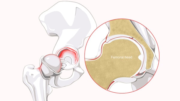 Medical illustration showing a close-up of the hip socket with labral tears