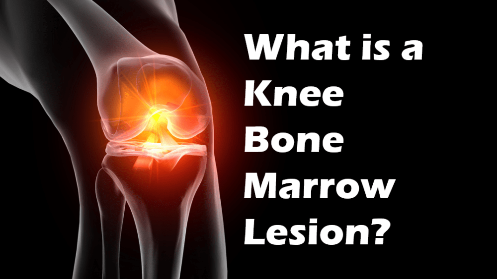 Why Are Knee Bone Marrow Lesions A Big Deal?