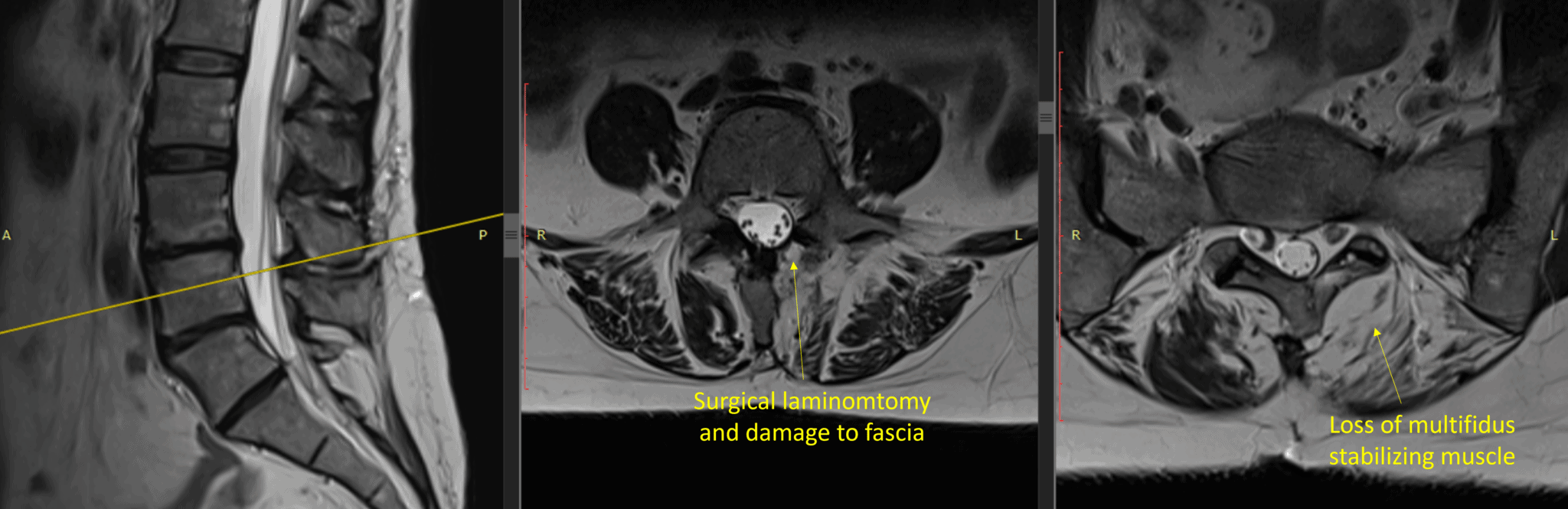 Pain After Back Surgery Tracy's Story Regenexx