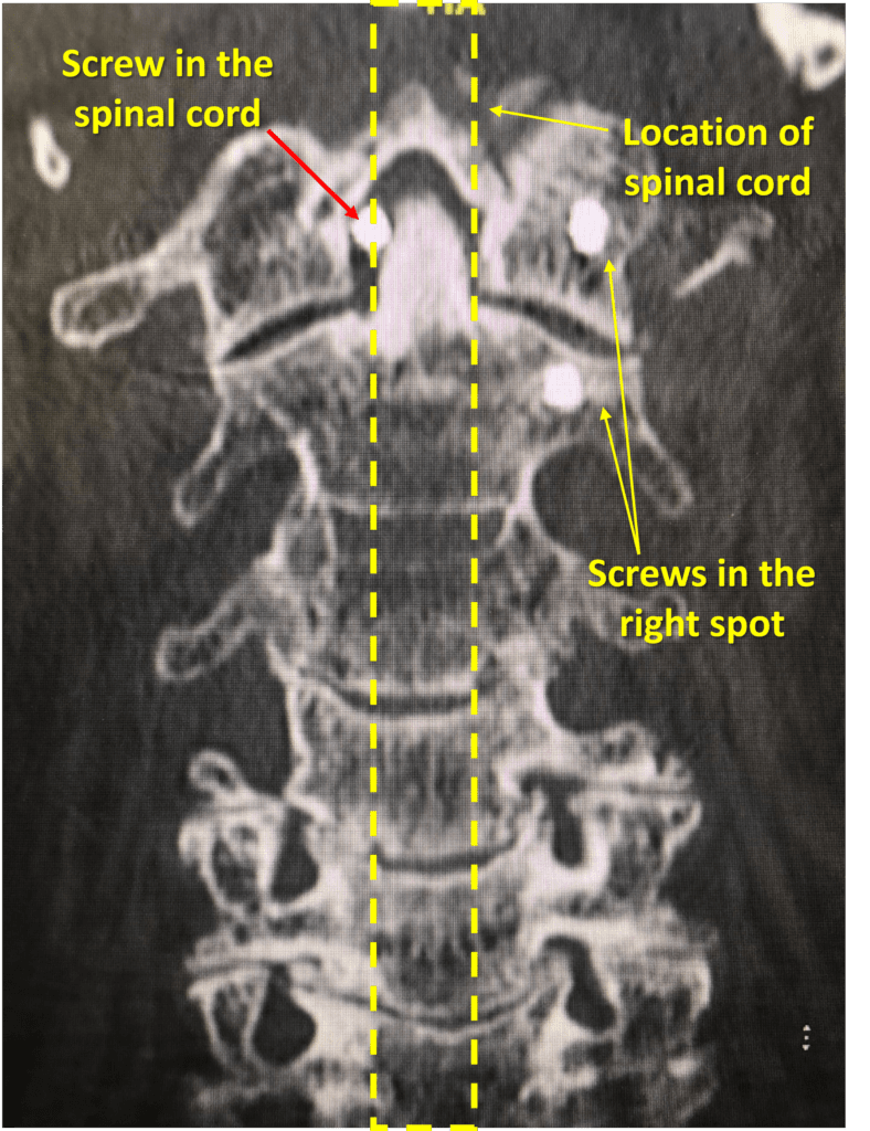 neck fusion complication screw in spinal cord