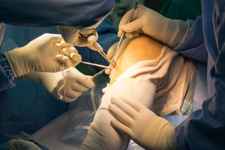 acl-surgery-is-not-cost-effective-in-new-study-regenexx