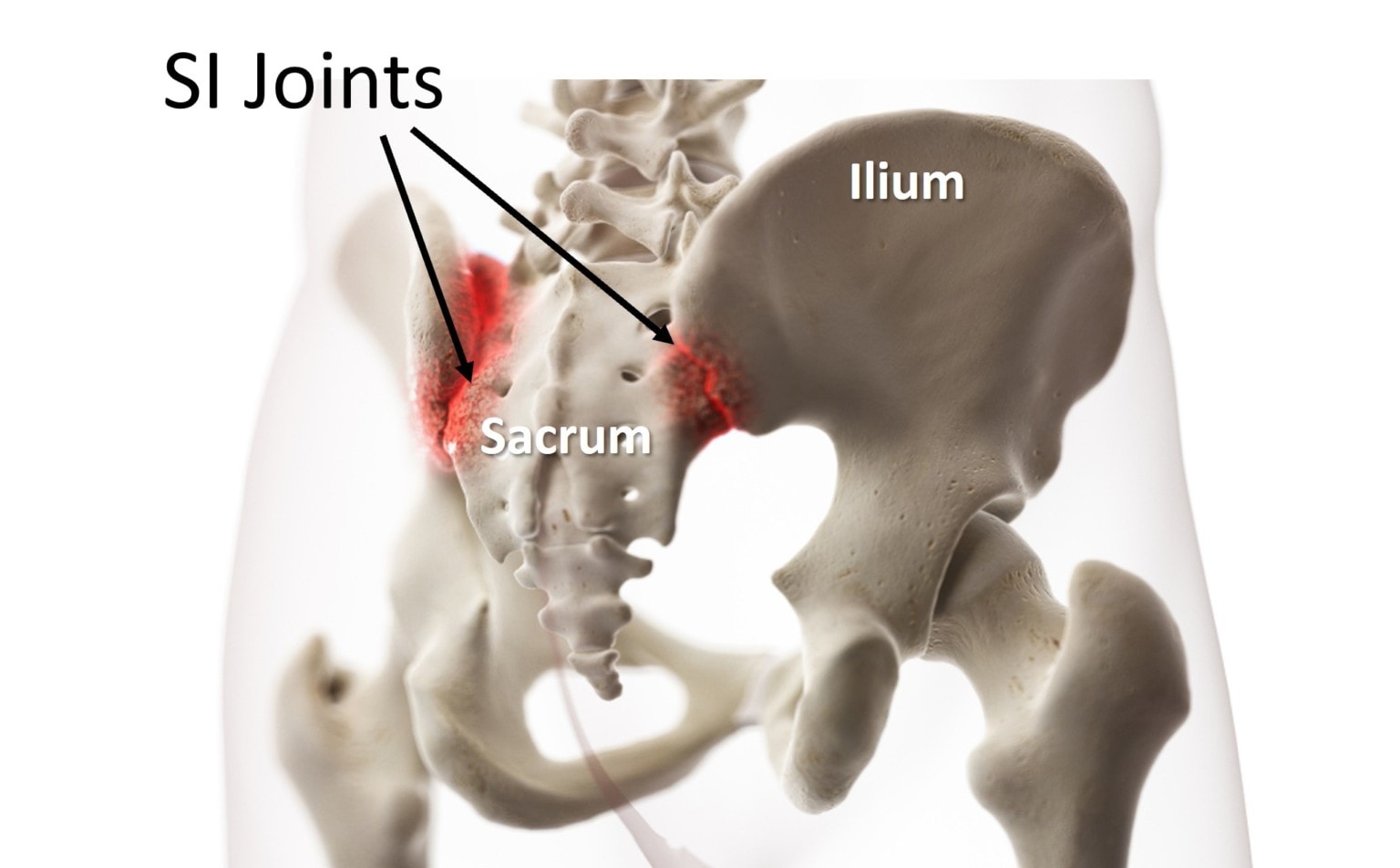 does-prp-work-to-treat-si-joint-pain-regenexx