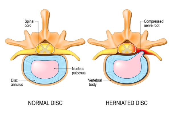Medical illustration showing a normal or healthy spinal disc and a herniated spinal disc side by side.