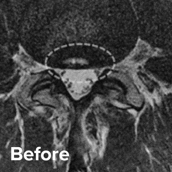 Regenexx for Disc Tears Regenexx