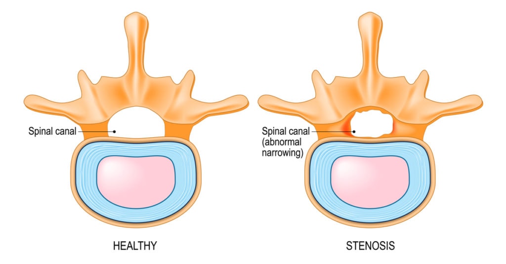 medical illustration showing a healthy spinal disc and a 