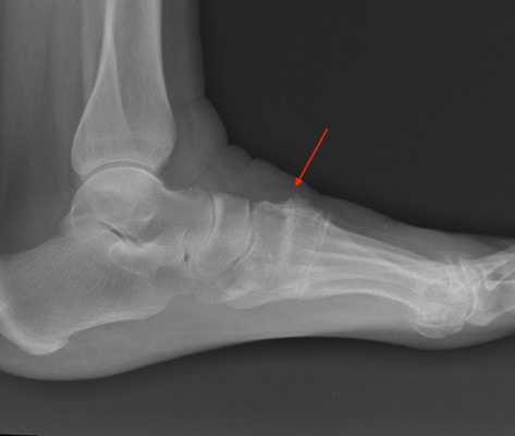 Getting Flat Feet? Meet the Spring Ligament - Regenexx