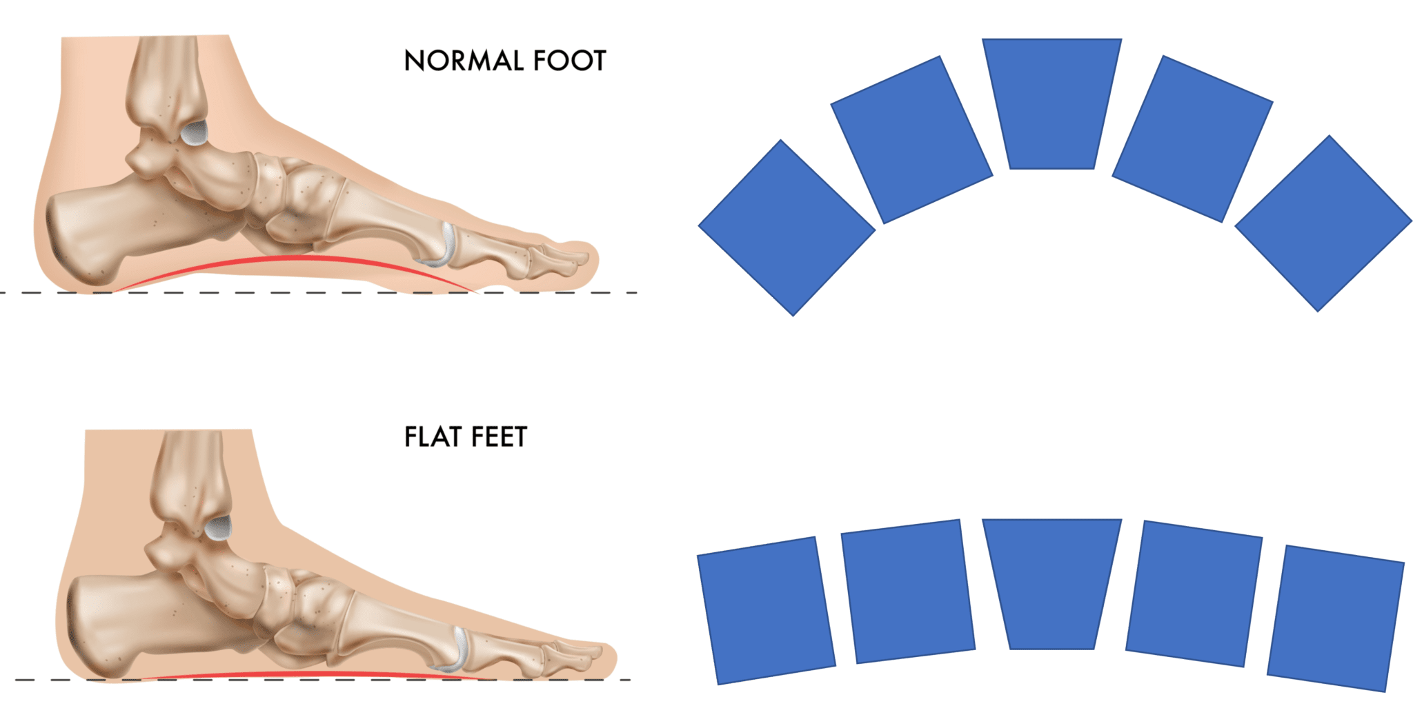 Getting Flat Feet? Meet the Spring Ligament Regenexx