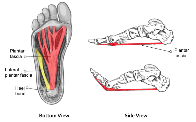 What Is a Plantar Fascia Tear? - Regenexx