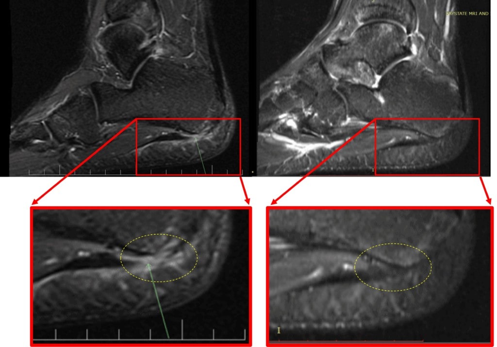 patient's plantar fascia tear mri image comparison