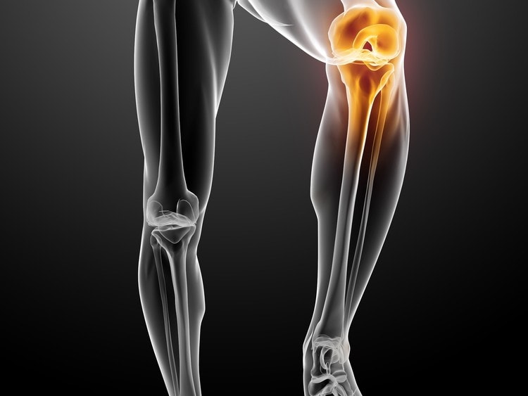 What My Unstable Knee Can Teach You About PRP Treatment
