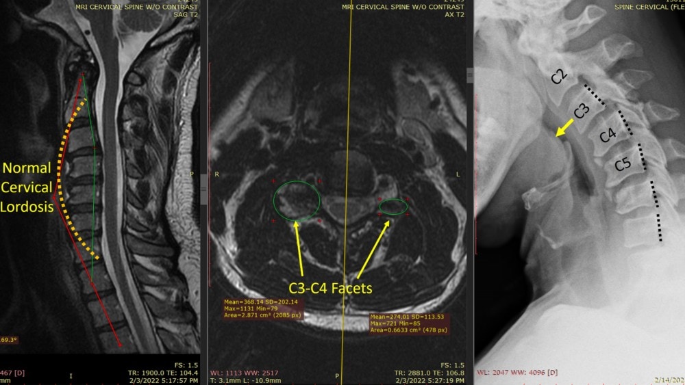 The Proper Use of Interventional Orthobiologics Requires Reading Your Own MRIs!