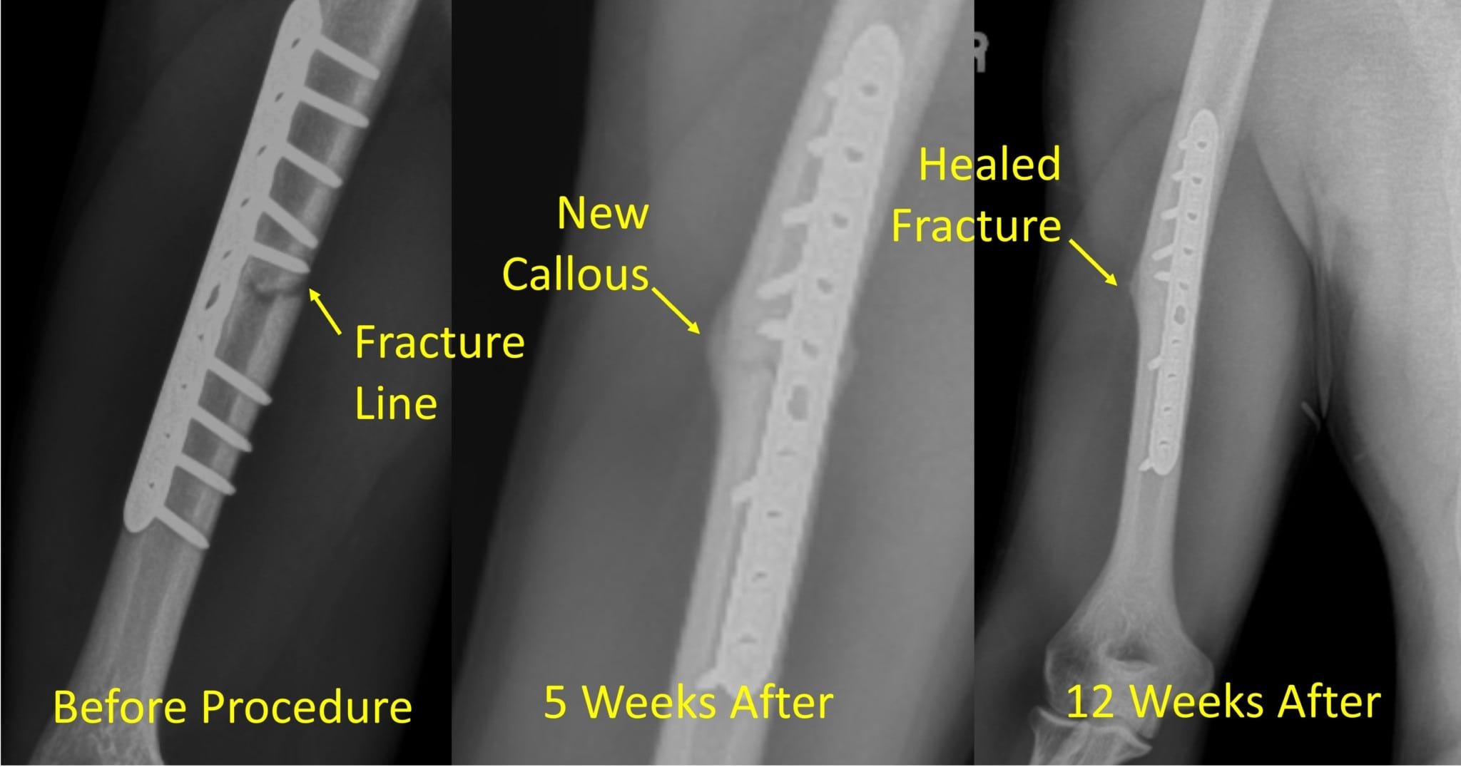 Bone Marrow Concentrate and Nonunion Fractures Regenexx