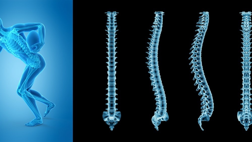 Sports vs Spine: Understanding Levels of Regen Spine Care