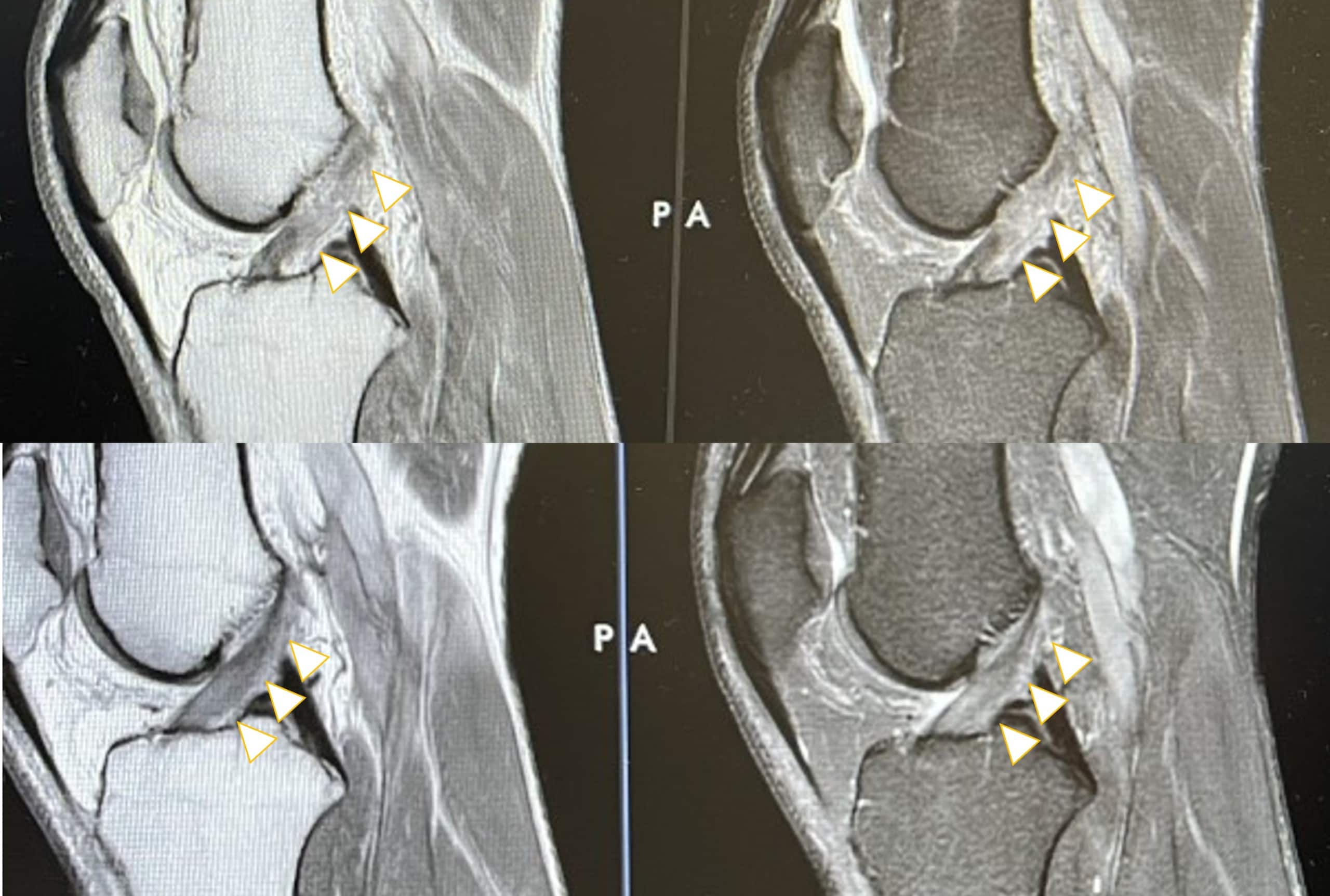 Healing Another ACL without Surgery - Regenexx