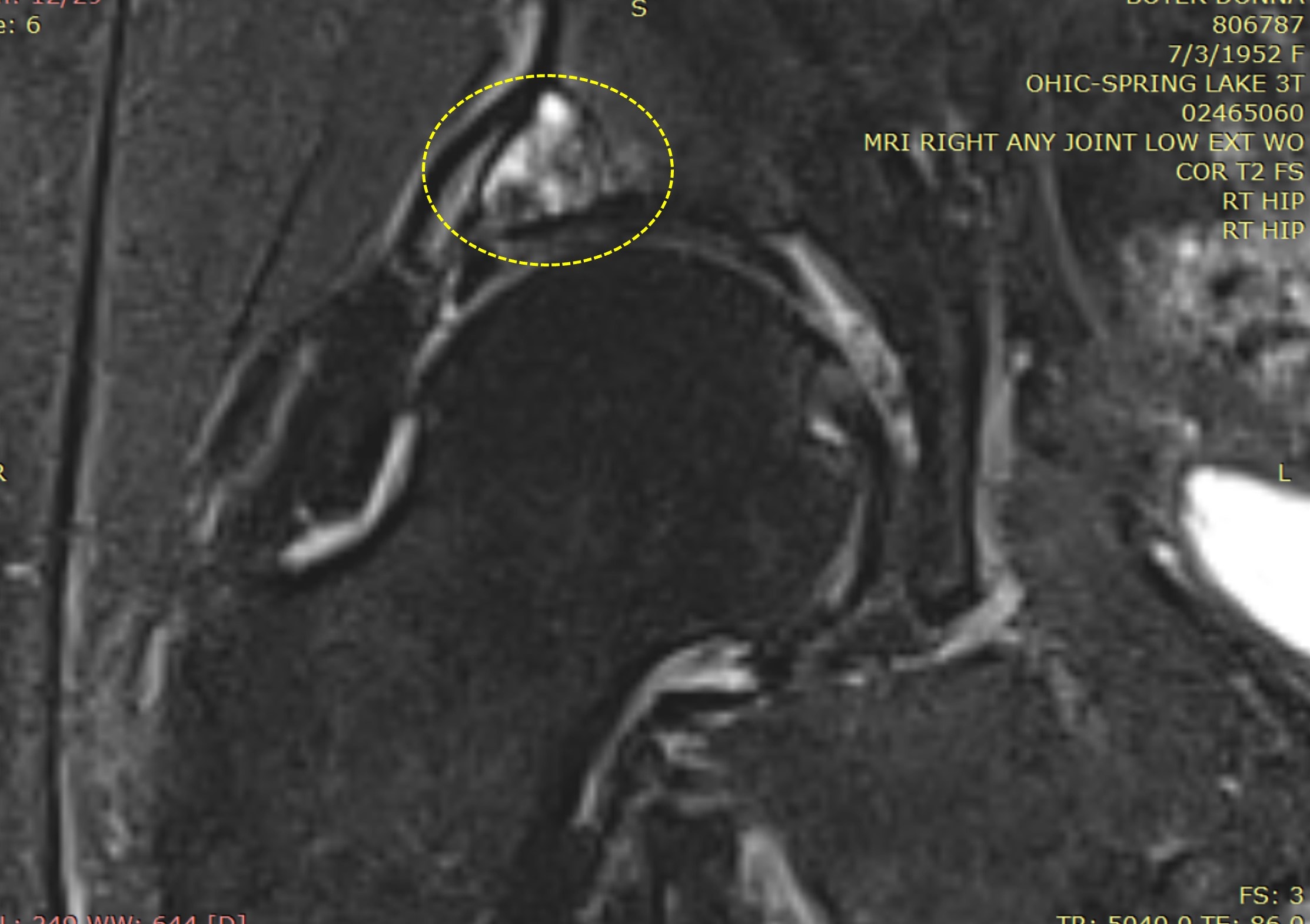 treating-an-acetabular-cyst-and-healing-the-hip-socket-regenexx