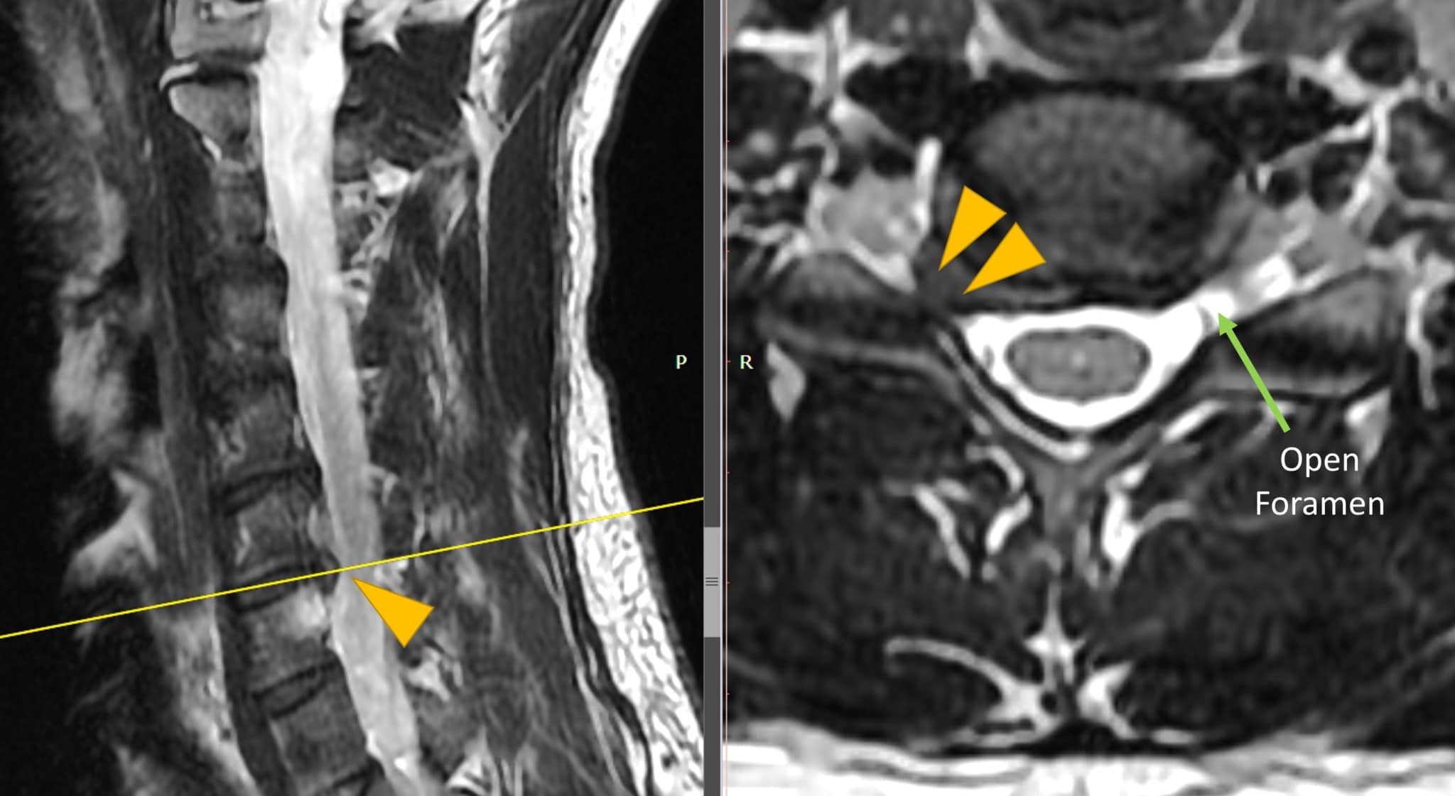 Can a Large Cervical Disc Bulge Be Treated with Platelets? Regenexx