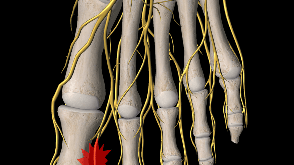 What is a Morton’s Neuroma?