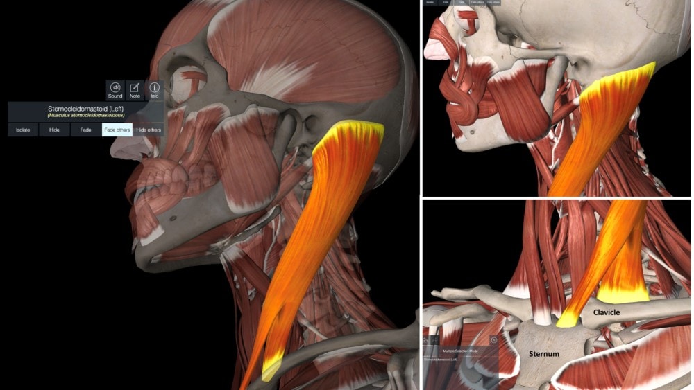 Sternocleidomastoid Syndrome: What You Need to Know