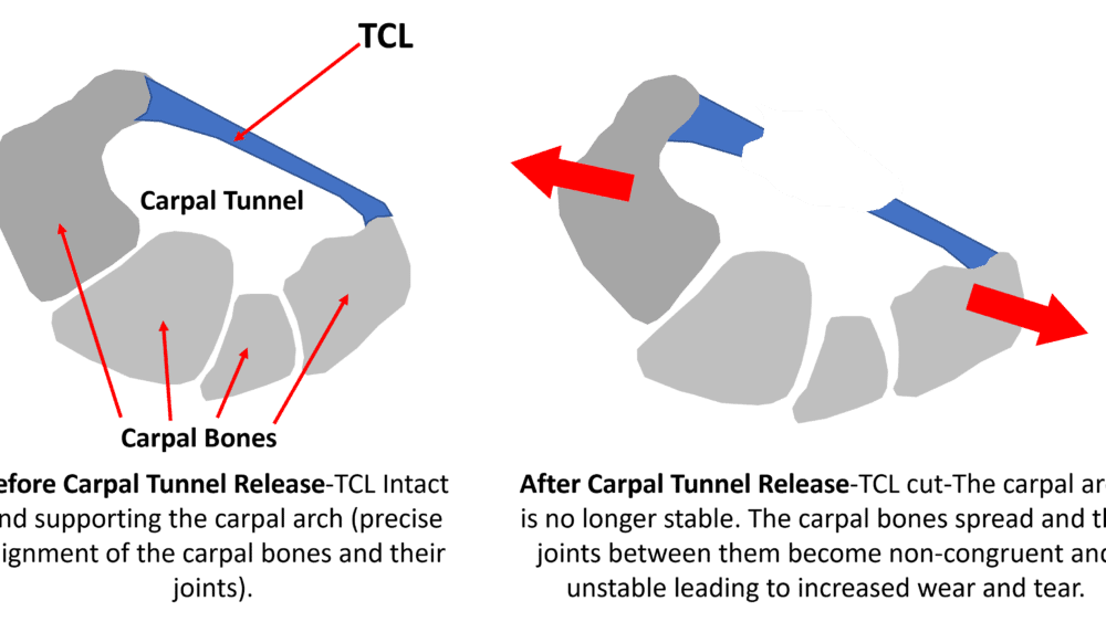 Carpal Tunnel Release and Wrist Instability