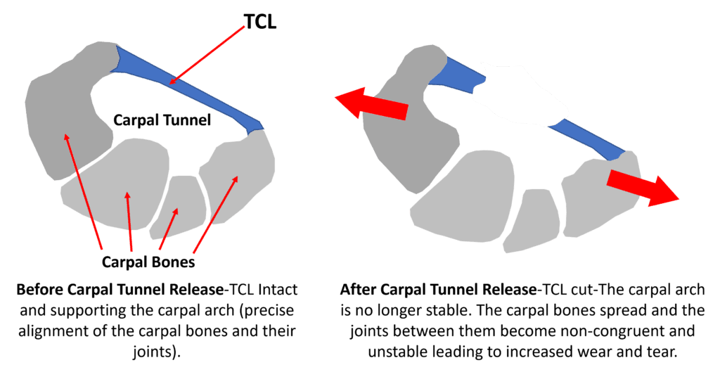 carpal tunnel surgery and wrist instability arthritis 2