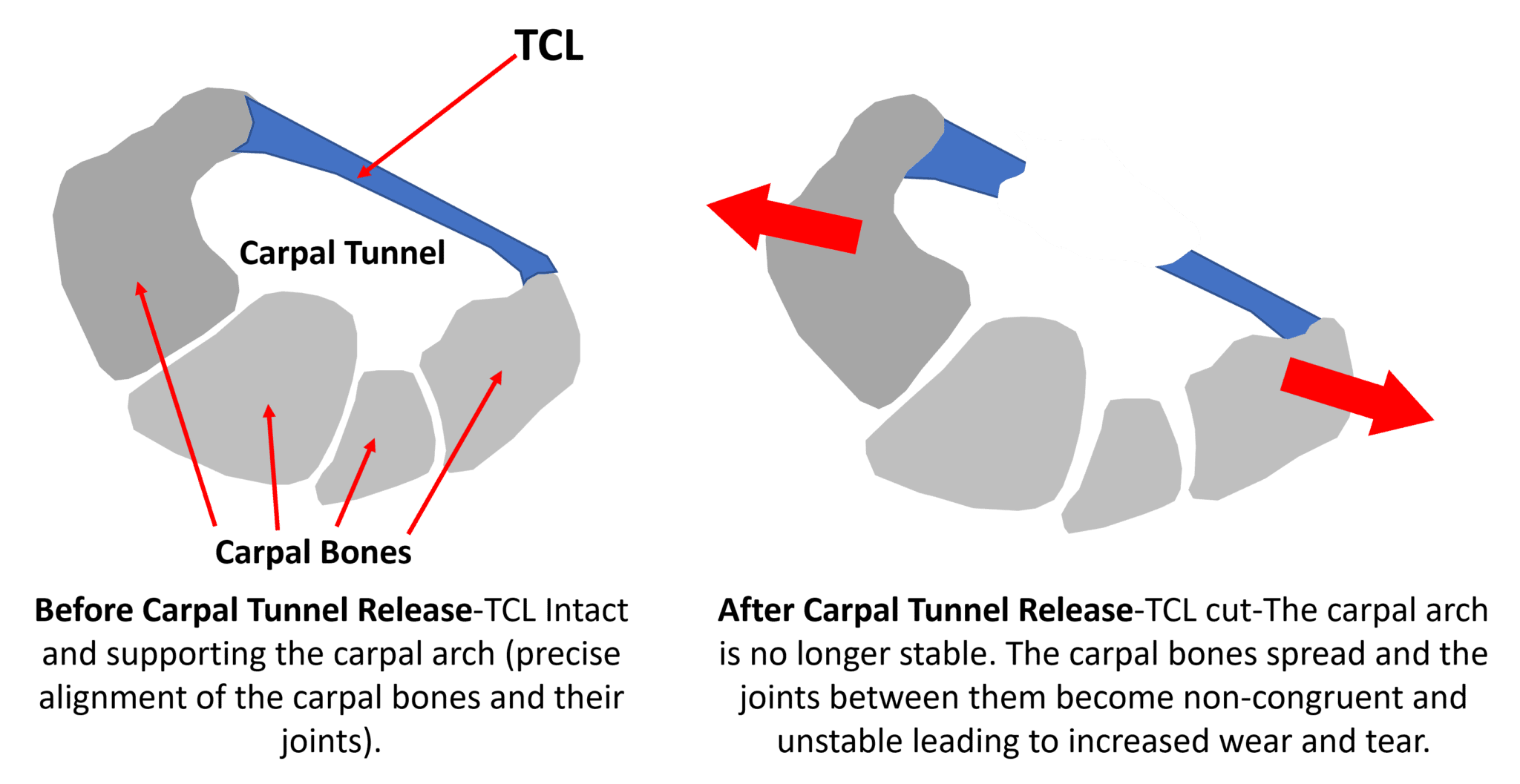 Carpal Tunnel Release and Wrist Instability - Regenexx