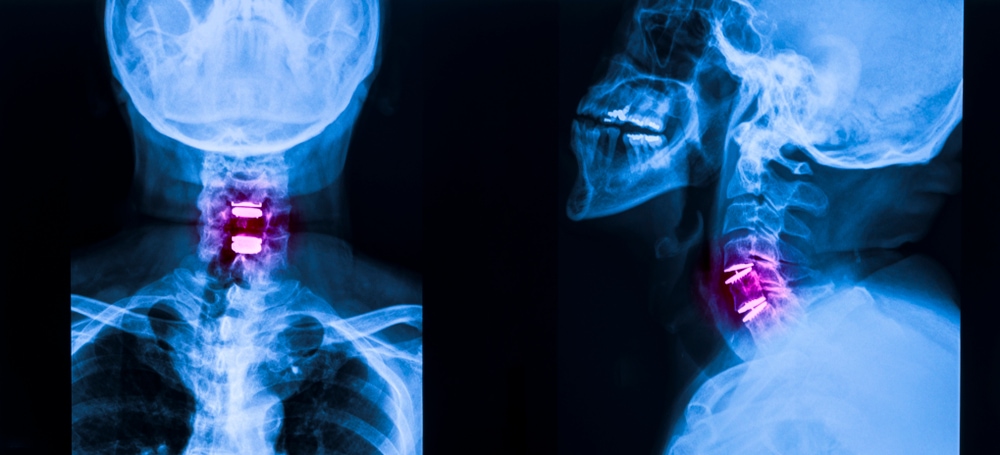 Living With Cervical Spinal Stenosis: My Story - Regenexx