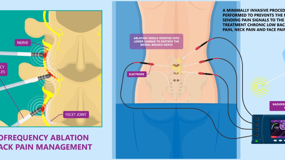 Regenerative vs. Ablative: The Battle Over Lumbar RFA and Multifidus Atrophy