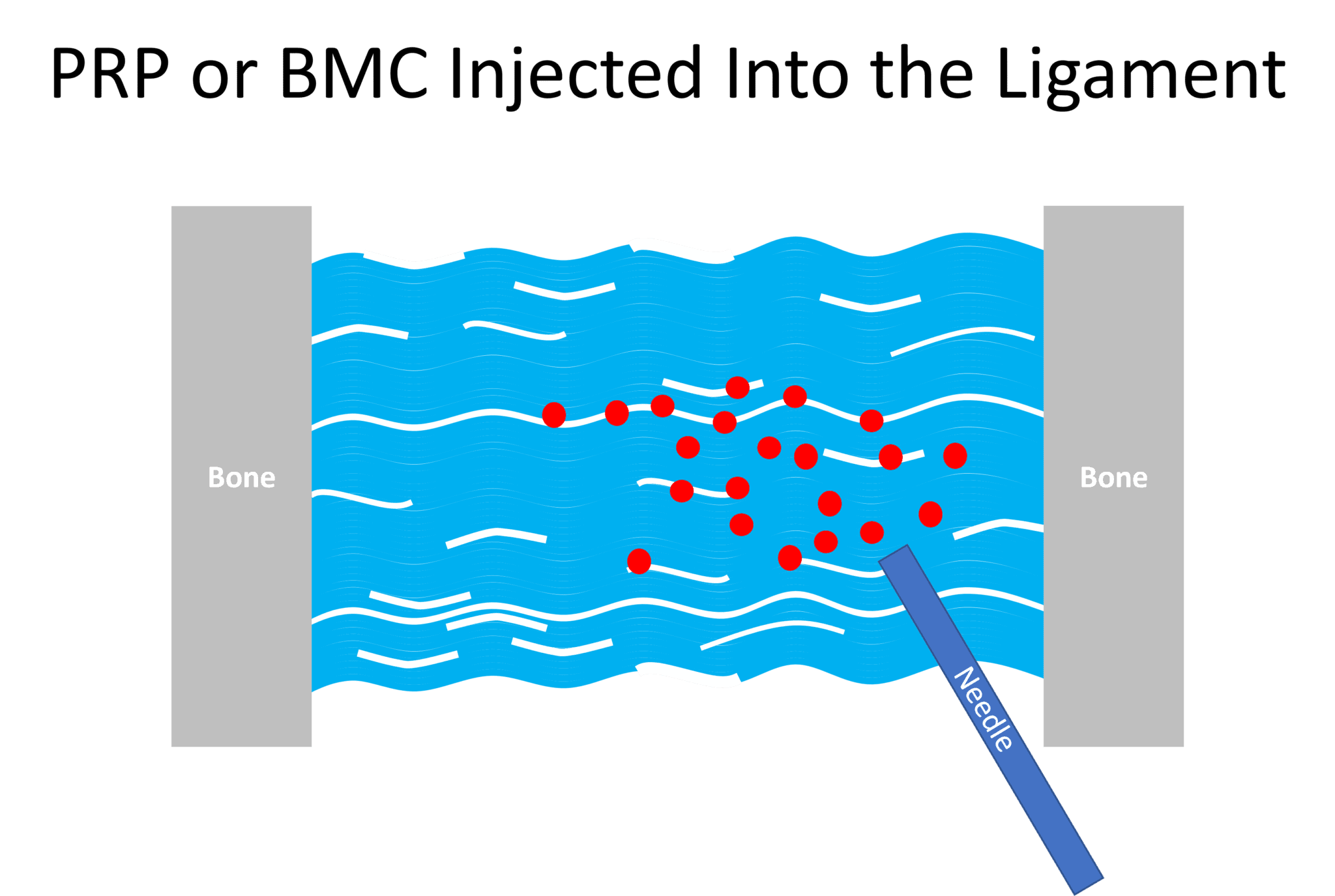 PRP Injections for Knee ACL Tears A Few Sandwiches Short of a Picnic Regenexx