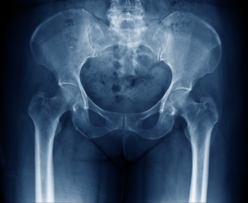 normal hip seiries xrays