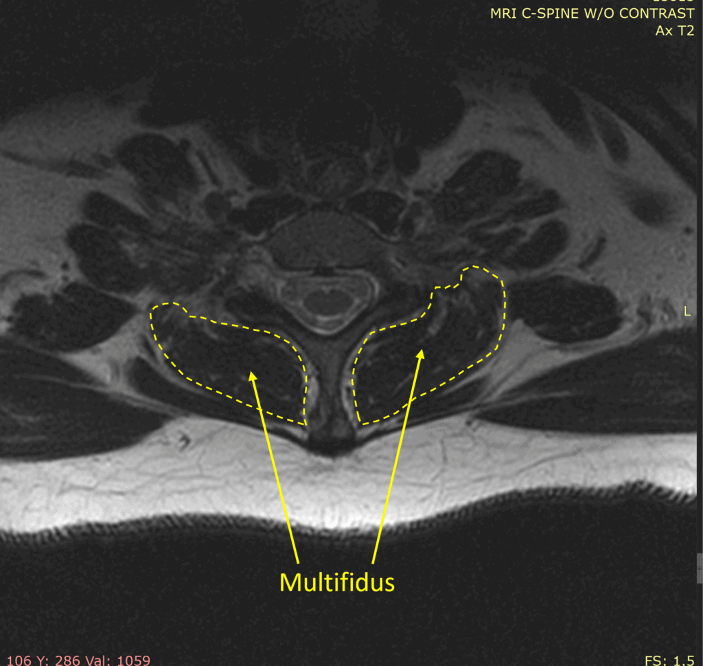 Multifidus Muscle Mri
