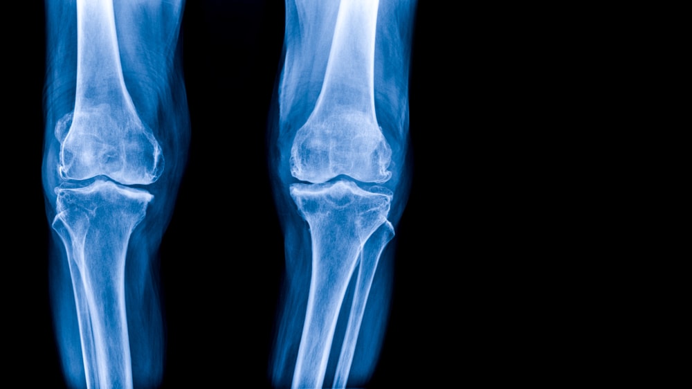 Traditional Medicine’s Approach to Treating Knee Arthritis is Blowing Up