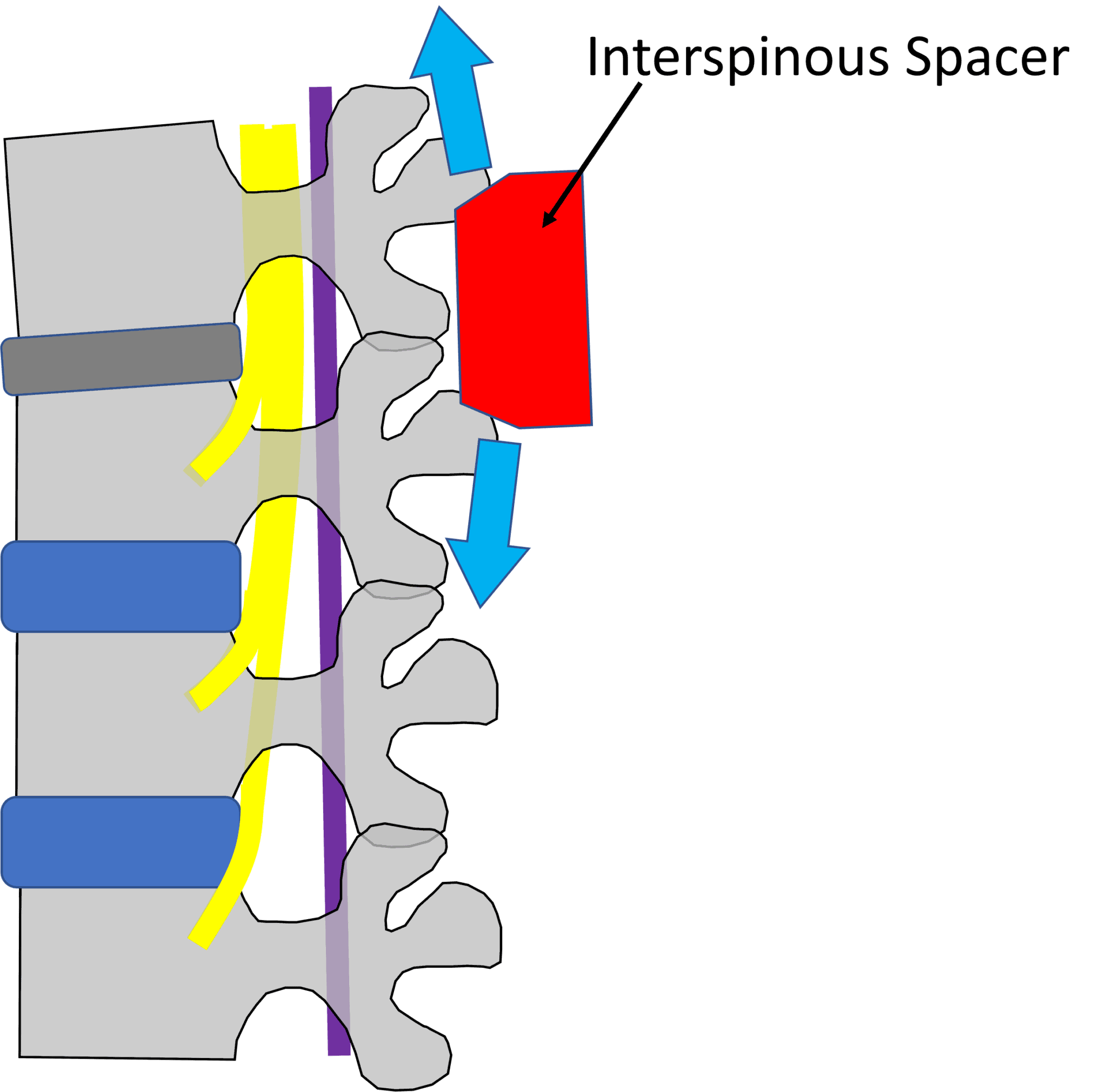 Interspinous Spacers The Best Thing Since Sliced Bread or a Bad Idea