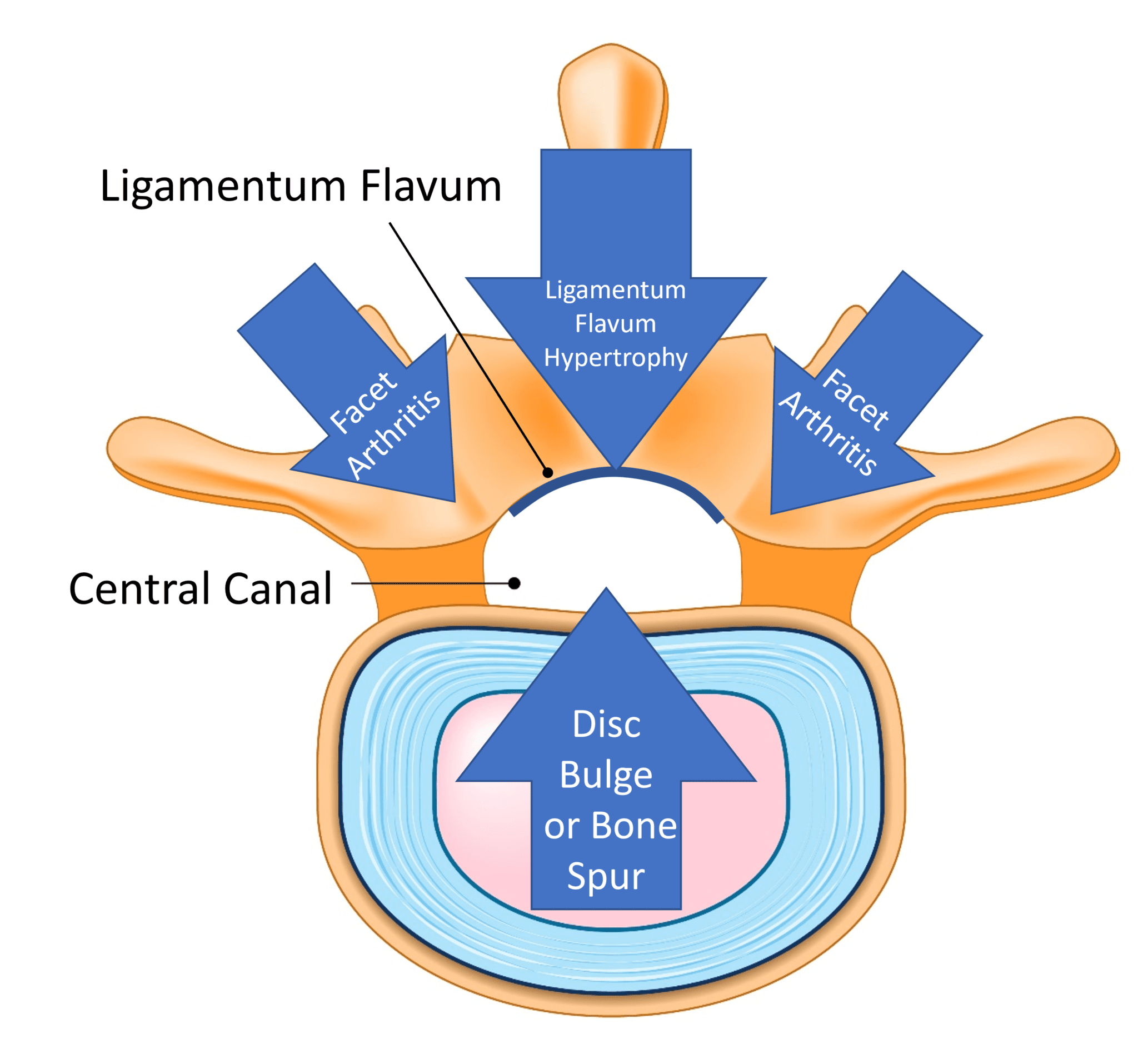 Interspinous Spacers The Best Thing Since Sliced Bread or a Bad Idea