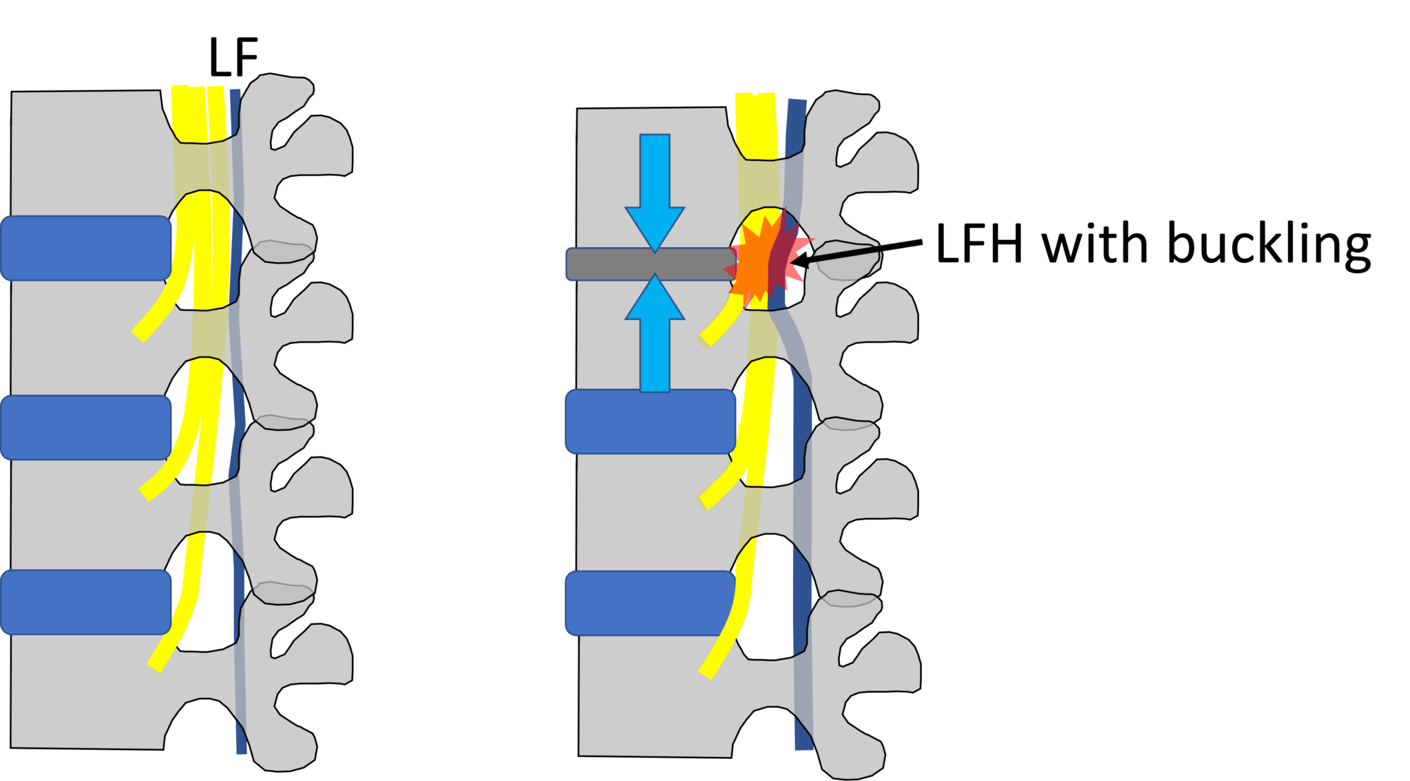 interspinous-spacers-the-best-thing-since-sliced-bread-or-a-bad-idea