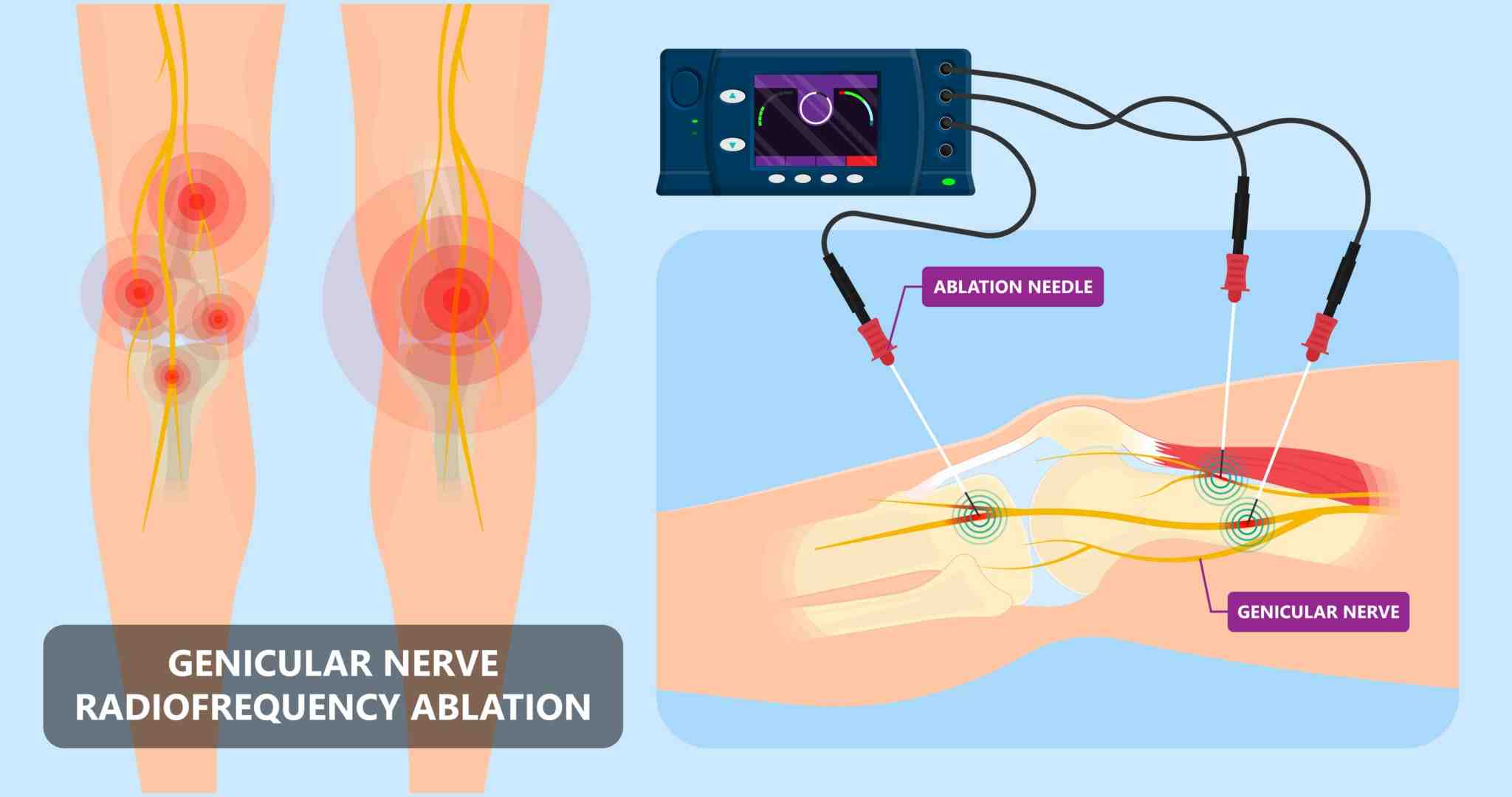 radiofrequency-pain-treatment-e-algos