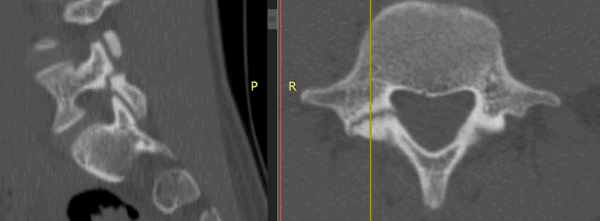 right sided pars fracture
