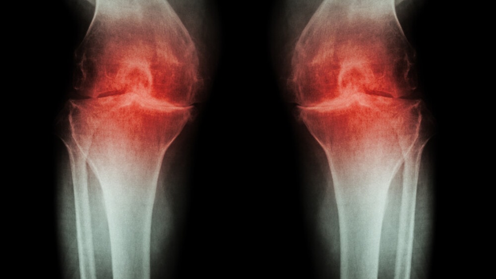 A Conflicted Sydney Scientist and a New Knee Arthritis Stem Cell Study