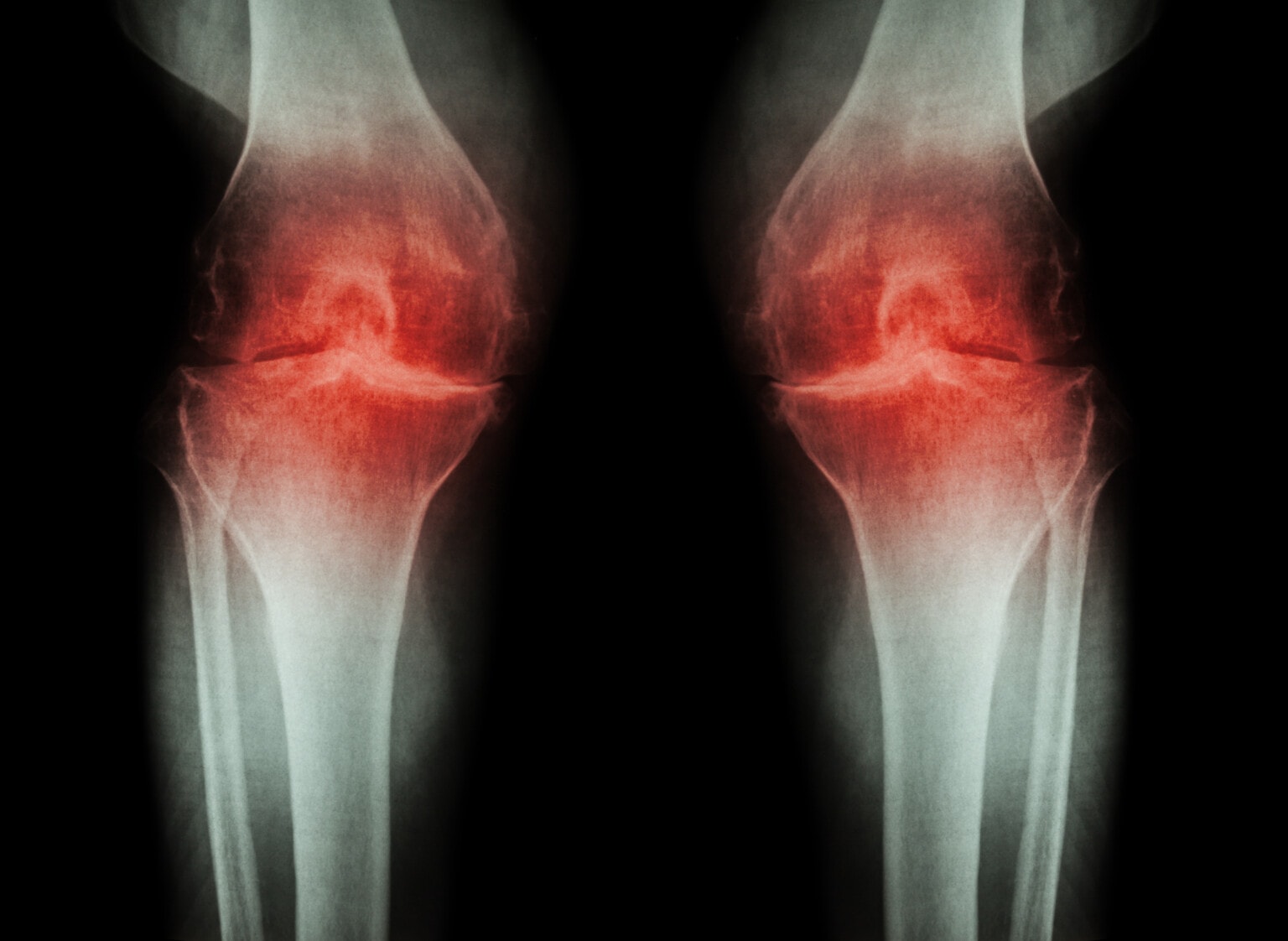 A Conflicted Sydney Scientist And A New Knee Arthritis Stem Cell Study