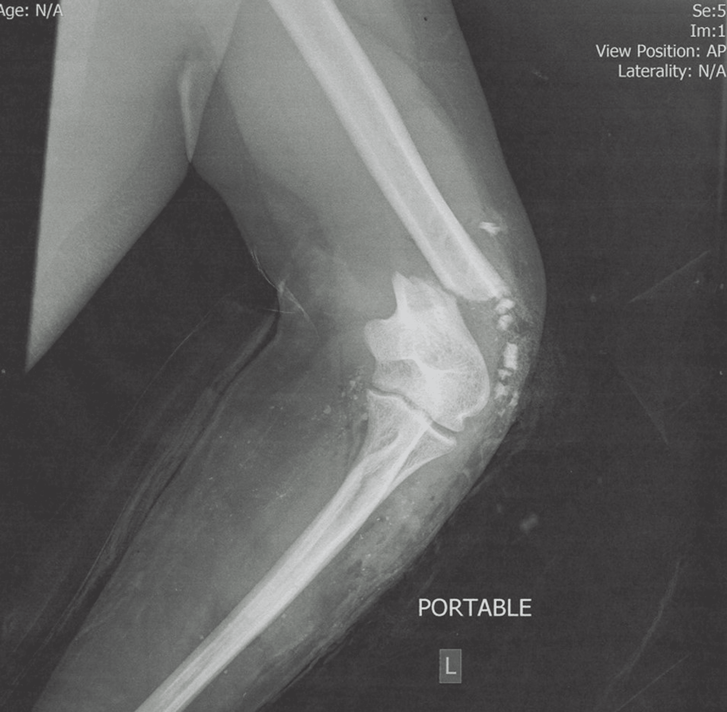Can an Intraosseous BMC Injection Mend a Non-healing Bone? - Regenexx