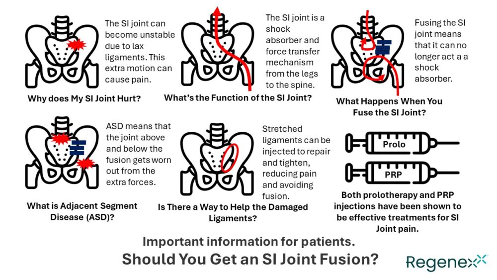 Should You Get an SI Fusion?