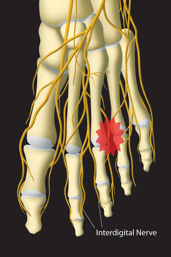 illustration of foot with morton's neuroma