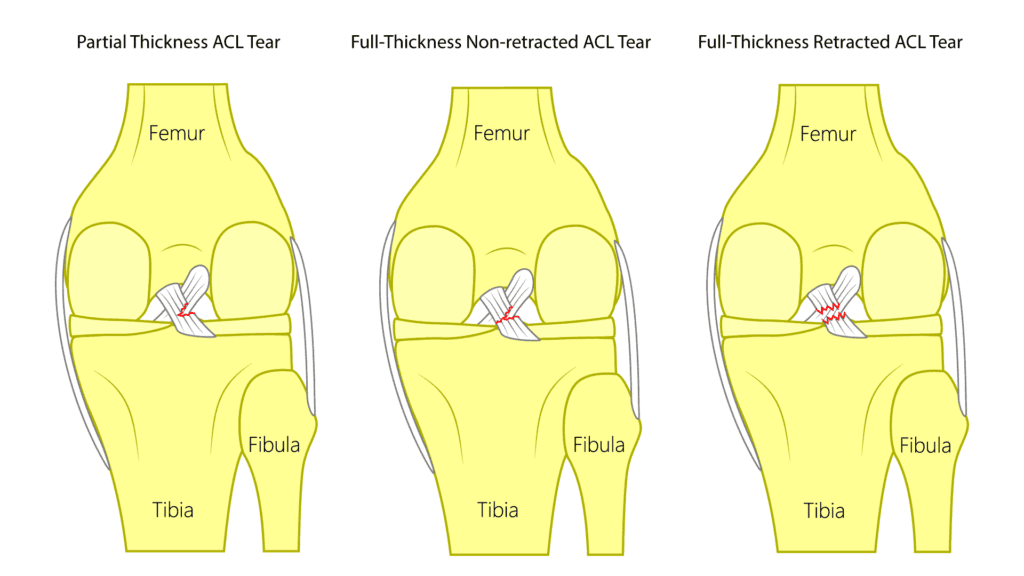 Different types of ACL tears