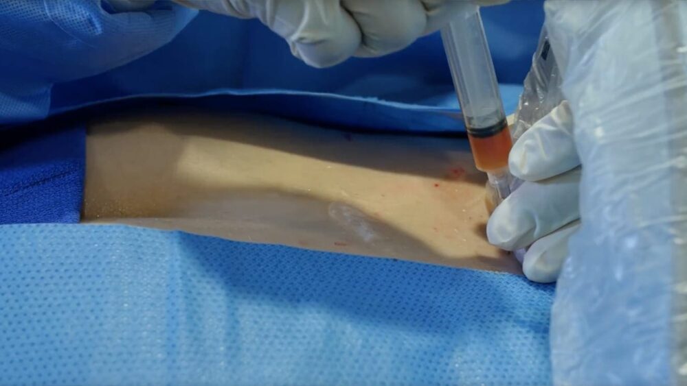 Continued Pain After Lower Back Surgery – Arcadia, CA