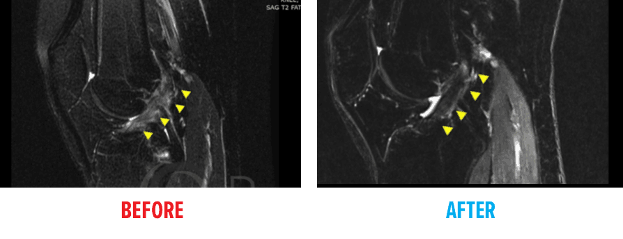 Knee MIR ACL Tear Before & After