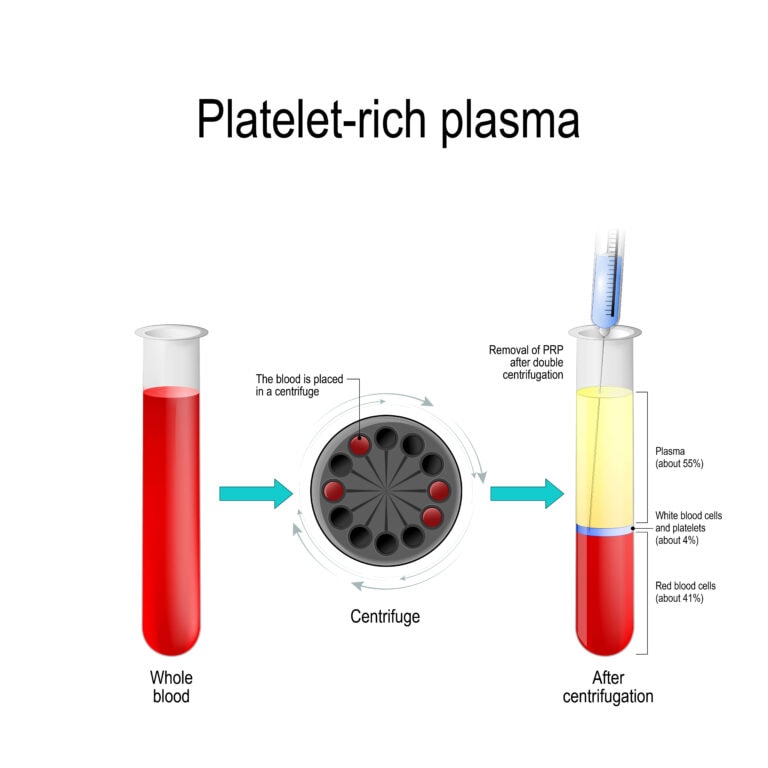 PRP Injection for Knee Pain - Regenexx-SCP Advanced Treatment