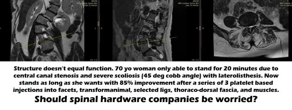 Scoliosis